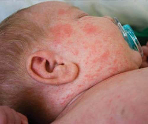 Piccole macchie rosse sulla pelle del bambino: cosa sono?