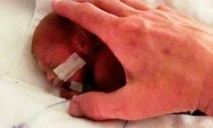 La storia del neonato più prematuro del mondo