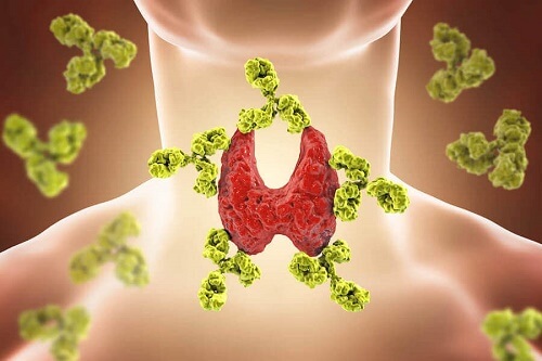 Visione 3d della Tiroidite di Hashimoto