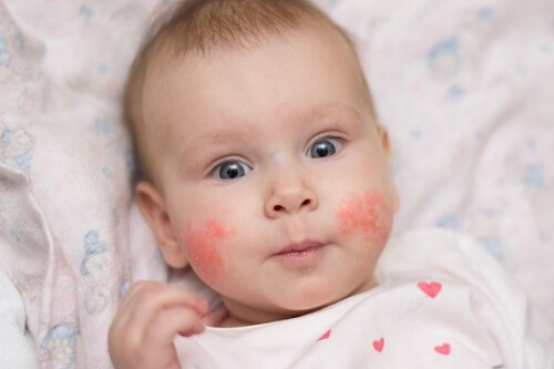 Dermatite atopica nei bambini: come prevenire i focolai