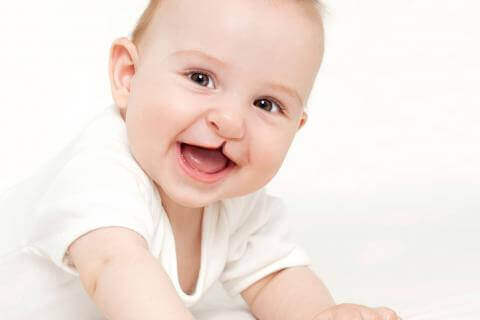 Labbro leporino e palatoschisi