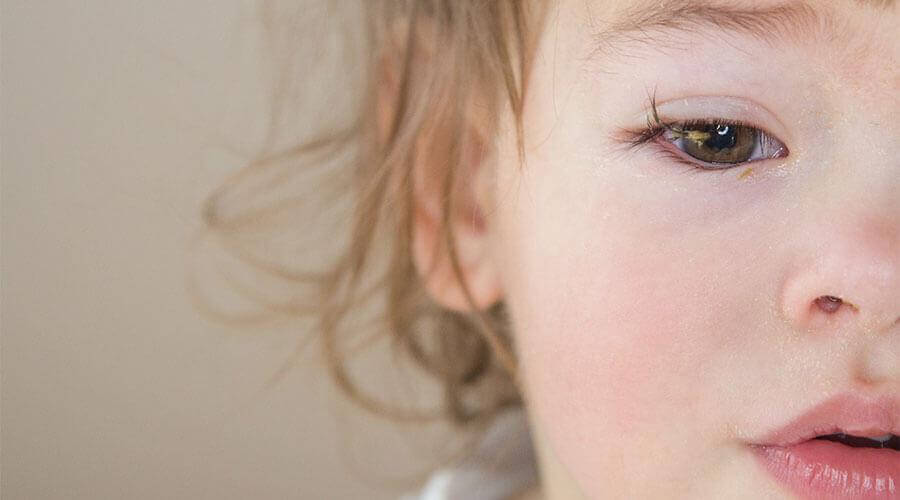 Congiuntivite nei bambini