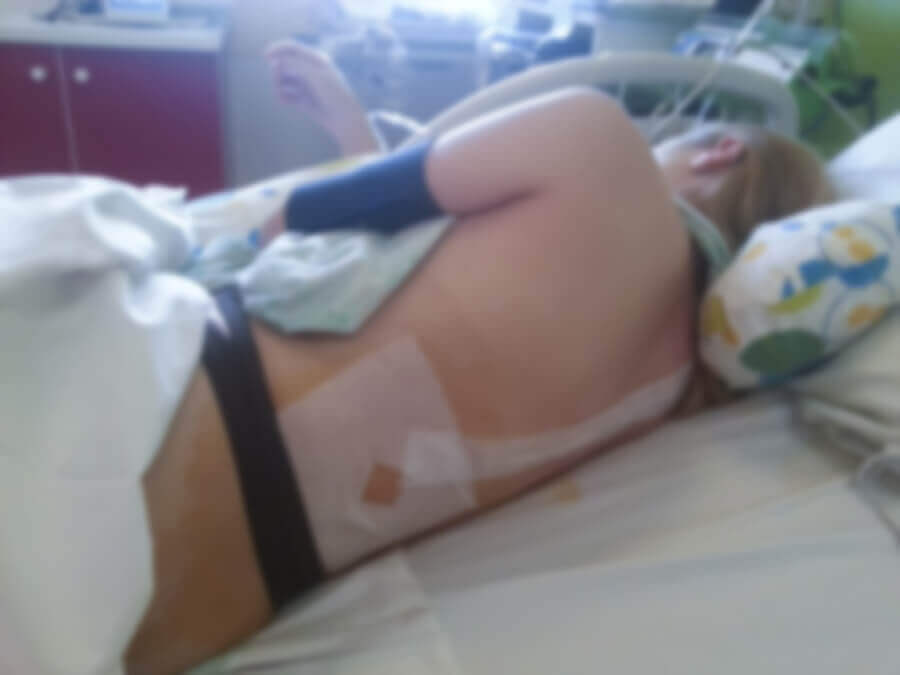 donna che ha fatto anestesia epidurale