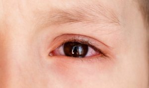 Emorragia sottocongiuntivale nei bambini: cosa fare