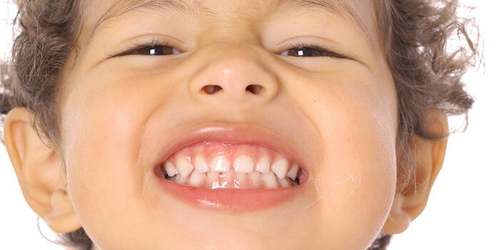 Bambino con bruxismo