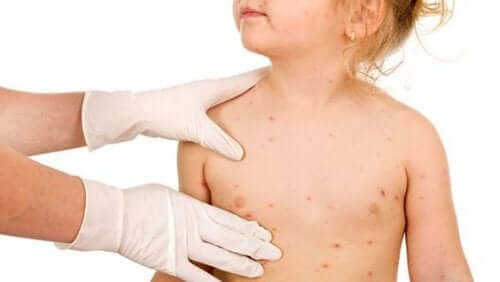 Dermatite erpetiforme: tracce di celiachia della pelle?
