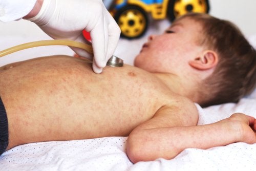 tra le complicazioni più gravi del morbillo troviamo quelle di carattere respiratorio