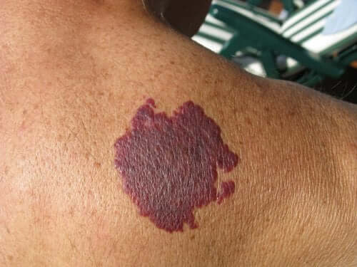 il sintomo più caratteristico della sindrome di Sturge-Weber è costituito dalla presenza di macchie color vino sulla pelle