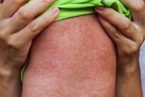 Le epidemie di morbillo e l'importanza della prevenzione