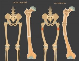 Rachitismo: la carenza di vitamina D nei bambini