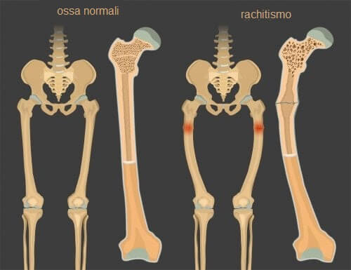 Rachitismo: la carenza di vitamina D nei bambini