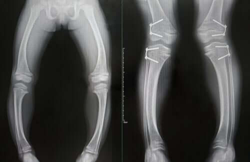 Radiografia alle ossa delle gambe con rachitismo