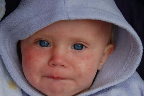 il morbillo è una malattia virale molto contagiosa che colpisce soprattutto i bambini