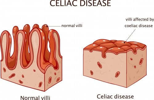 malattia celiaca particolare su villi intestinali
