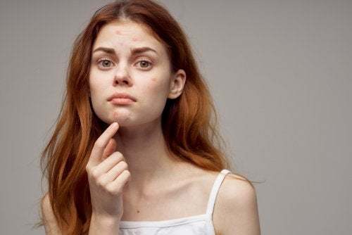 Adolescente con i brufoli