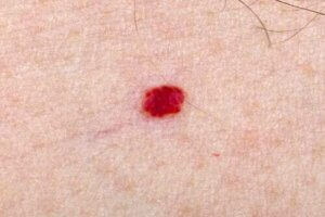 Come si cura un angioma della pelle nei bambini?
