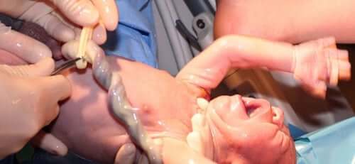 Nascita neonato con cordone ombelicale.