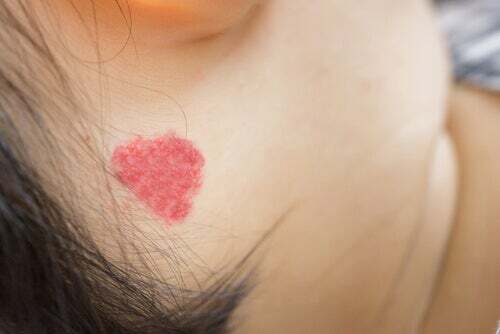 Macchia sulla pelle. Come si cura l'angioma nei bambini.