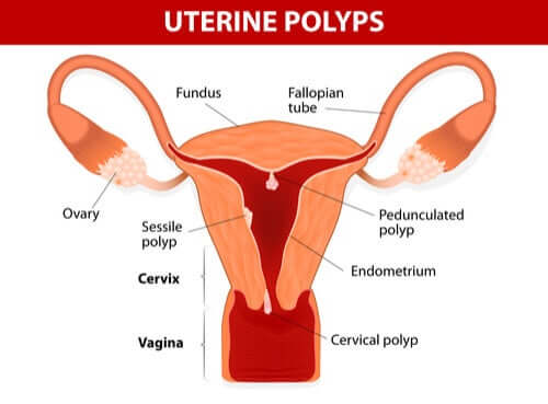 Struttura utero e polipi uterini.