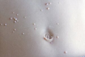Mollusco contagioso: cosa fare contro questa infezione?