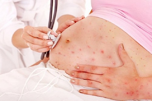 La sindrome della varicella congenita