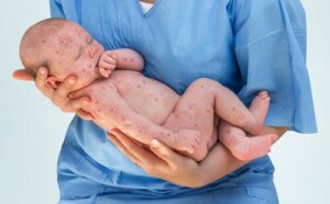 Il morbillo nei bambini: sintomi, trattamento e prevenzione