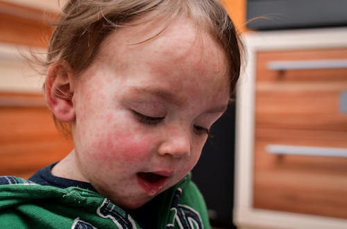 Bambino con il volti pieno di sfoghi a causa di una allergia alle proteine del latte vaccino.