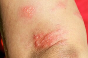 Pemfigoide gestazionale: cos'è e come trattarlo?
