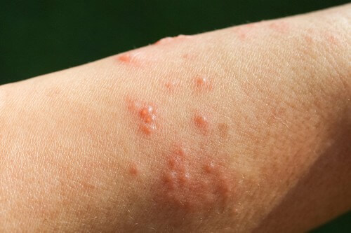 Pemfigoide gestazionale.