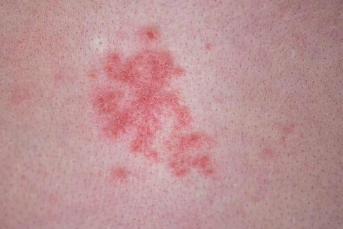 Eczemi sulla pelle.