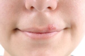 Herpes nei bambini: manifestazione e trattamento naturale