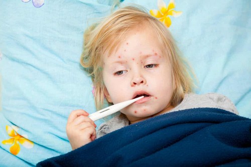Macchie di koplik e morbillo.