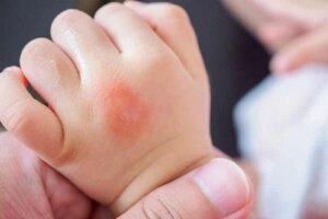 Individuare le punture di insetti nei bambini: come riuscirci?