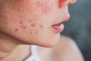 Acne in gravidanza: combatterla con l'aiuto di 10 rimedi casalinghi