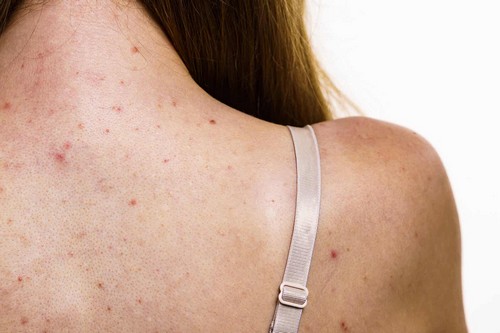 Acne sulla schiena.