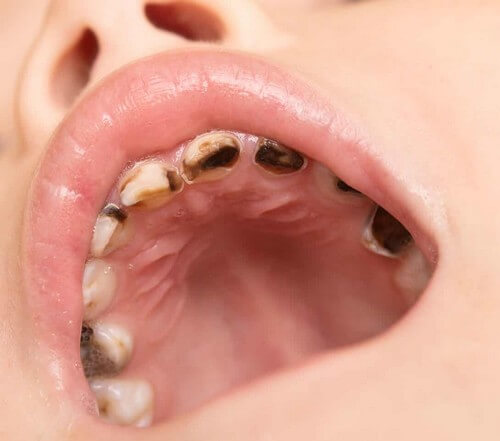 Carie ai denti.