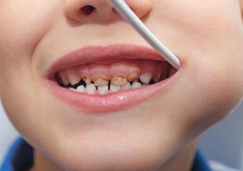 Denti da latte neri: perché succede a mio figlio?