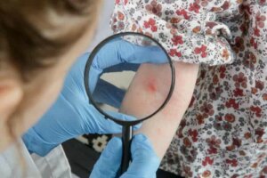 Dermatite atopica nei neonati e nei bambini: rimedi naturali
