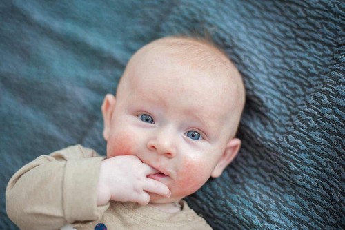 Neonato con eczema.