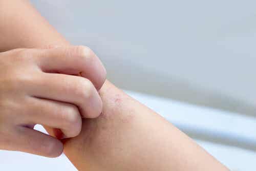 Macchie bianche sulla pelle dei bambini: quali sono le cause?
