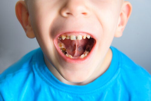 Denti da latte macchiati: cause e rimedi
