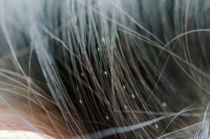 Lendini: cosa sono e come eliminarle?