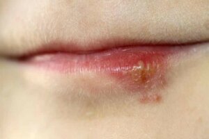 Herpes labiale in gravidanza: ecco cosa c'è da sapere