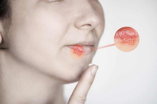 Herpes labiale.