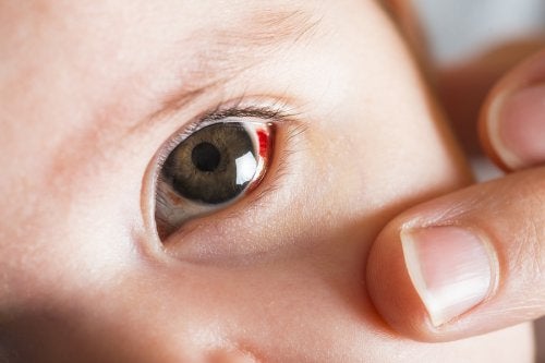 Macchie rosse negli occhi dei neonati: cosa sono?