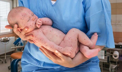 Neonato con dermatite.