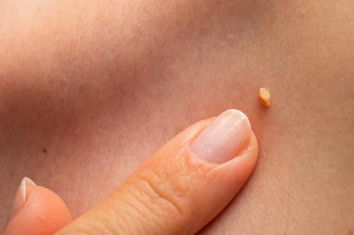 Fibromi penduli in gravidanza: tutto ciò che dovreste sapere