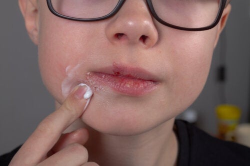 Herpes labiale nei bambini: cos'è e come trattarlo