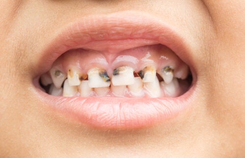 Carie nei denti da latte: è necessario intervenire per curarle?