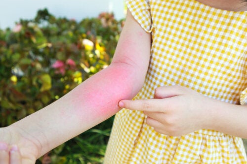 Dermatite da contatto nei bambini: curatela con alcuni pratici consigli